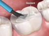 TRÁM BÍT HỐ RÃNH LÀ GÌ?  GIẢI PHÁP PHÒNG NGỪA SÂU RĂNG HIỆU QUẢ CHO BÉ