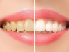 LỰA CHỌN TẨY TRẮNG RĂNG TẠI NHÀ HAY PHÒNG KHÁM NHA KHOA? NHỮNG ĐIỀU BẠN CẦN LƯU Ý