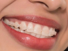 Niềng Răng Thẩm Mỹ