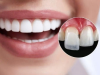 Răng Sứ Veneer Thẩm Mỹ