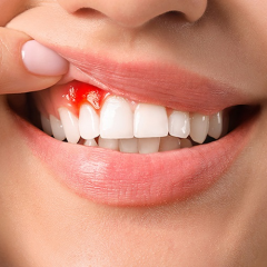 Nguyên Nhân Gây Chảy Máu Chân Răng Và Cách Điều Trị