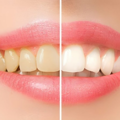 LỰA CHỌN TẨY TRẮNG RĂNG TẠI NHÀ HAY PHÒNG KHÁM NHA KHOA? NHỮNG ĐIỀU BẠN CẦN LƯU Ý