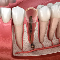 ĐIỀU TRỊ TUỶ RĂNG: DẤU HIỆU  CỦA RĂNG CẦN LẤY TUỶ