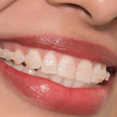 Niềng Răng Thẩm Mỹ