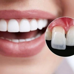 Răng Sứ Veneer Thẩm Mỹ