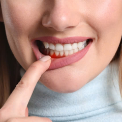 Điều Trị Viêm Nha Chu
