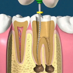 Điều Trị Tủy Răng