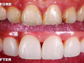 Trám răng thẩm mỹ