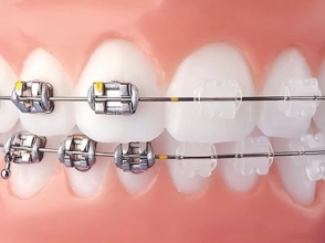 Niềng răng mắc cài