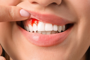 Nguyên Nhân Gây Chảy Máu Chân Răng Và Cách Điều Trị