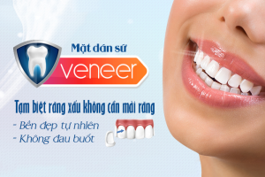 Dán Sứ Đẹp Tự Nhiên tại Nha Khoa LEVA