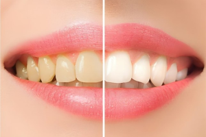 LỰA CHỌN TẨY TRẮNG RĂNG TẠI NHÀ HAY PHÒNG KHÁM NHA KHOA? NHỮNG ĐIỀU BẠN CẦN LƯU Ý