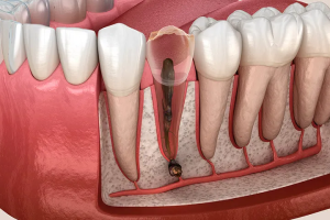 ĐIỀU TRỊ TUỶ RĂNG: DẤU HIỆU  CỦA RĂNG CẦN LẤY TUỶ