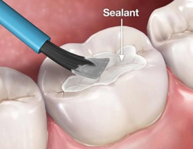 TRÁM BÍT HỐ RÃNH LÀ GÌ?  GIẢI PHÁP PHÒNG NGỪA SÂU RĂNG HIỆU QUẢ CHO BÉ